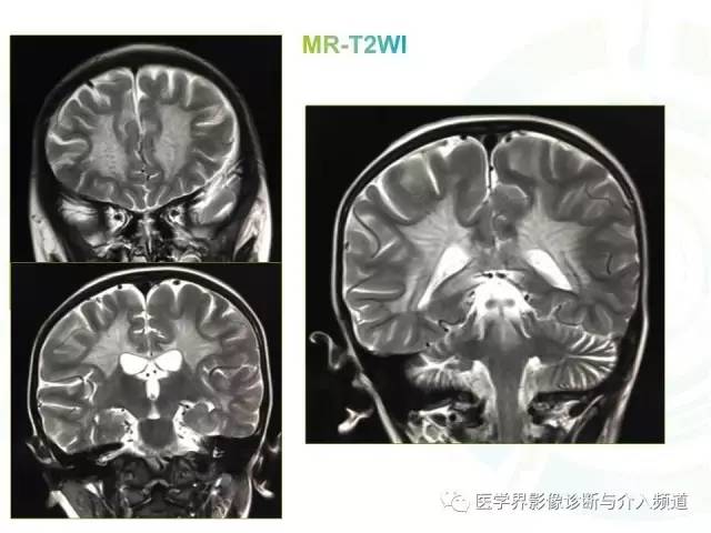 【病例】异染性脑白质营养不良1例MR影像诊断