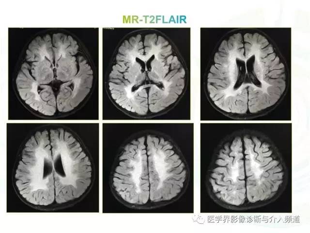 【病例】异染性脑白质营养不良1例MR影像诊断