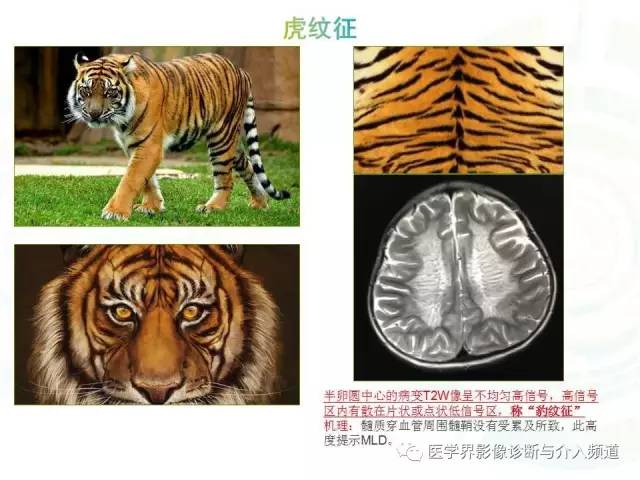 【病例】异染性脑白质营养不良1例MR影像诊断