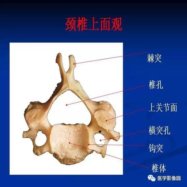 【PPT】颈椎病影像诊断