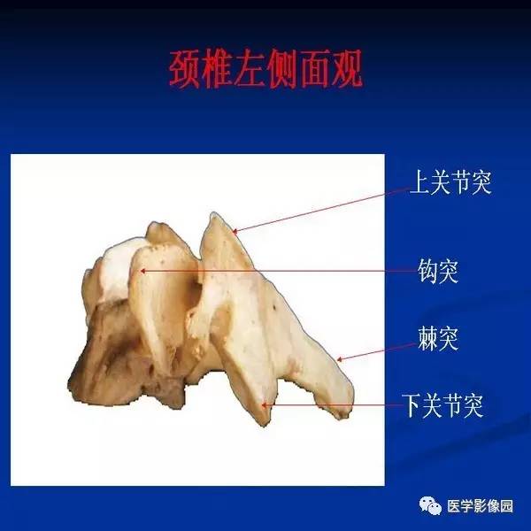 【PPT】颈椎病影像诊断
