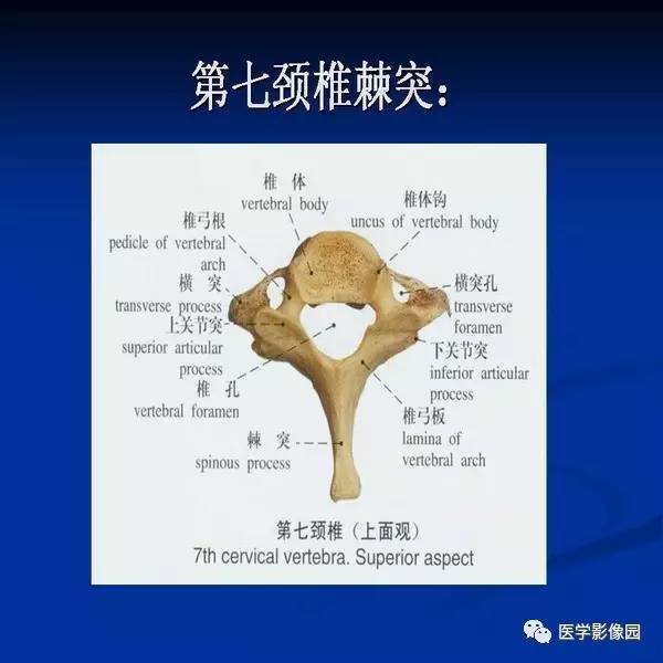 【PPT】颈椎病影像诊断