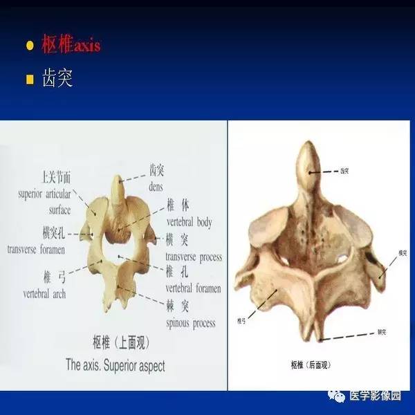 【PPT】颈椎病影像诊断