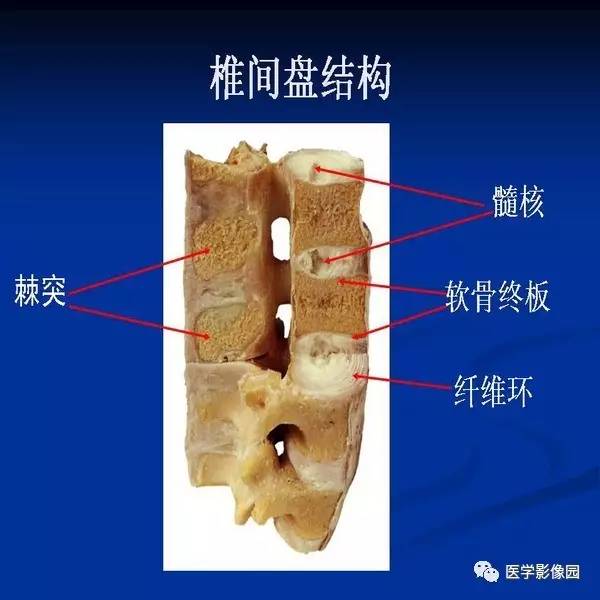 【PPT】颈椎病影像诊断