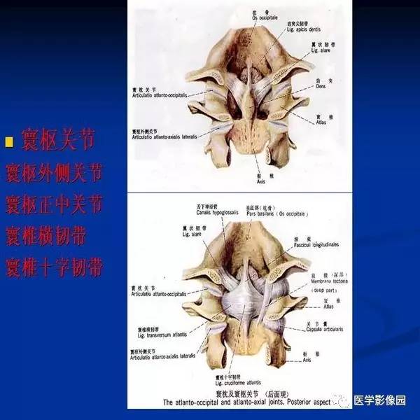 【PPT】颈椎病影像诊断