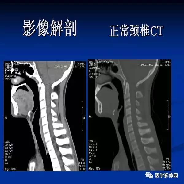 【PPT】颈椎病影像诊断
