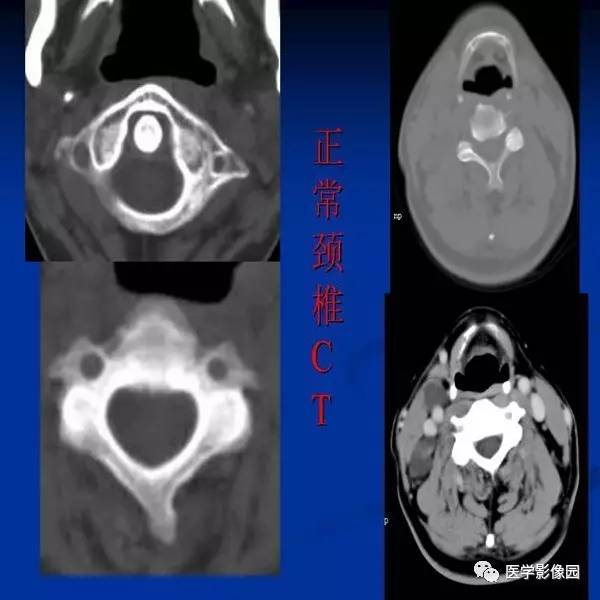【PPT】颈椎病影像诊断