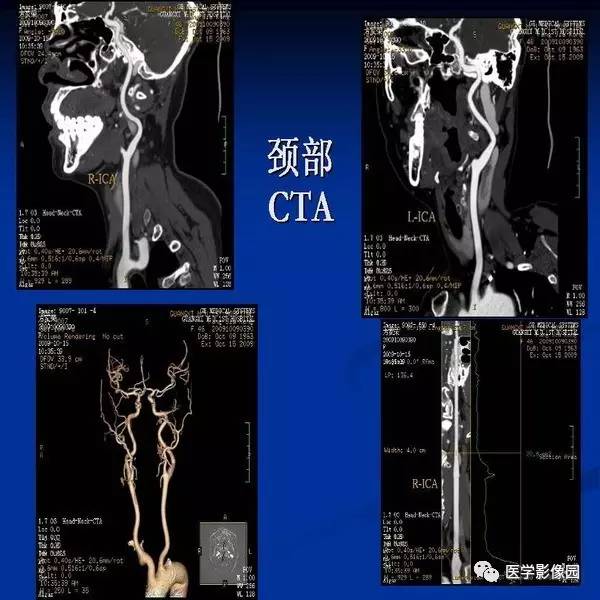 【PPT】颈椎病影像诊断