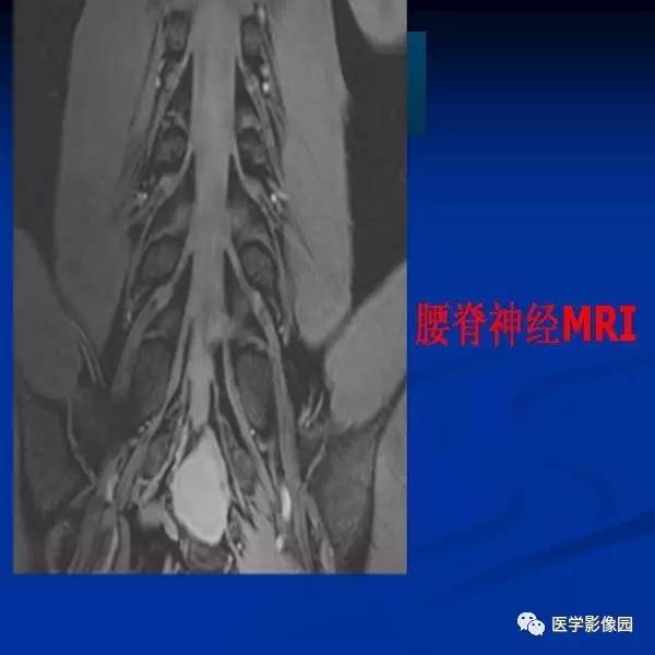 【PPT】颈椎病影像诊断