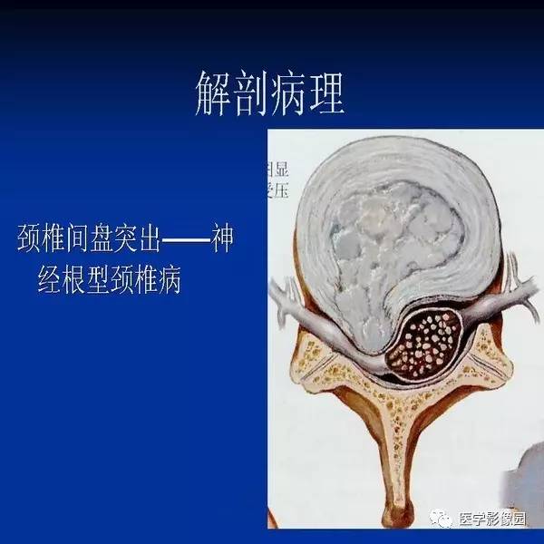 【PPT】颈椎病影像诊断