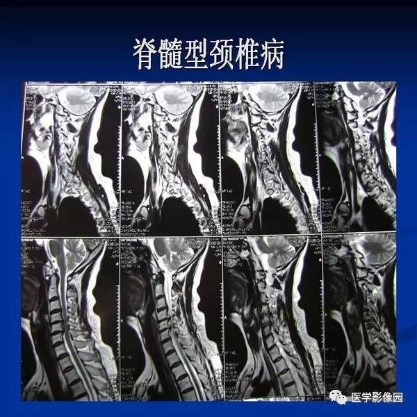【PPT】颈椎病影像诊断
