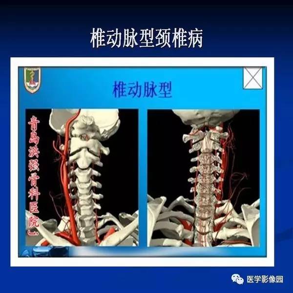 【PPT】颈椎病影像诊断