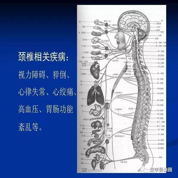 【PPT】颈椎病影像诊断