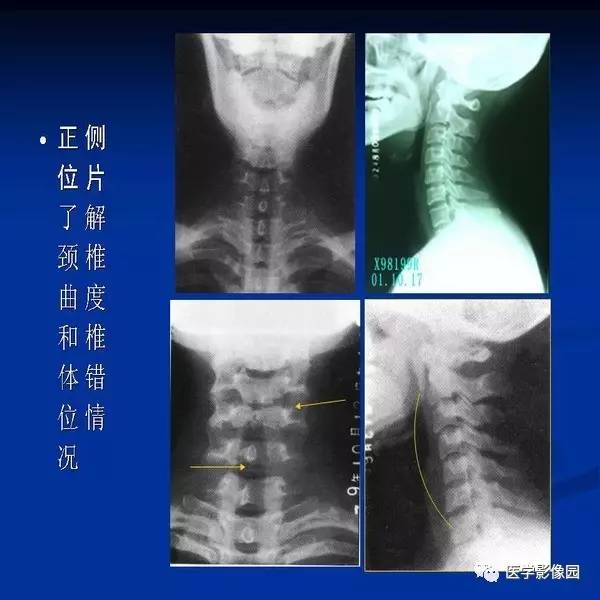 【PPT】颈椎病影像诊断
