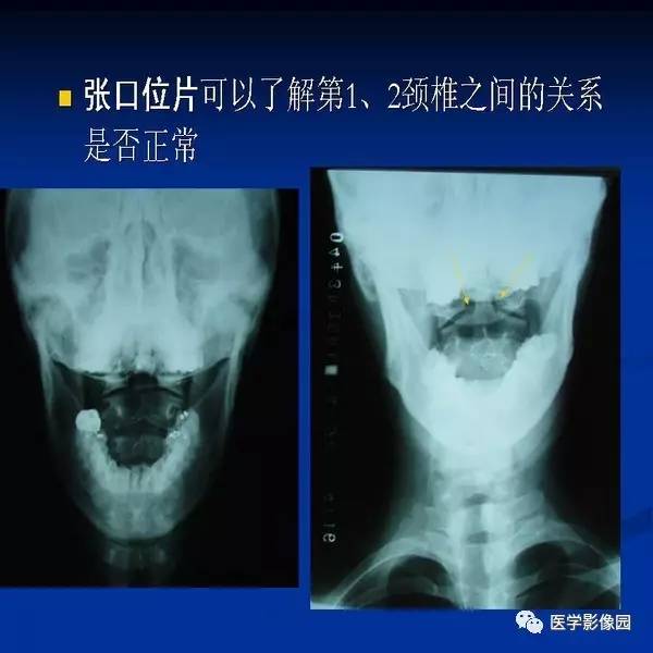 【PPT】颈椎病影像诊断