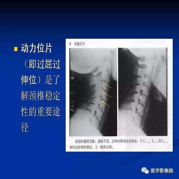 【PPT】颈椎病影像诊断