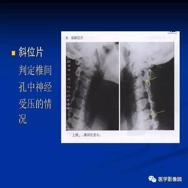【PPT】颈椎病影像诊断