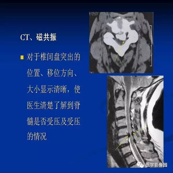【PPT】颈椎病影像诊断
