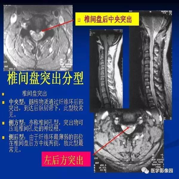 【PPT】颈椎病影像诊断