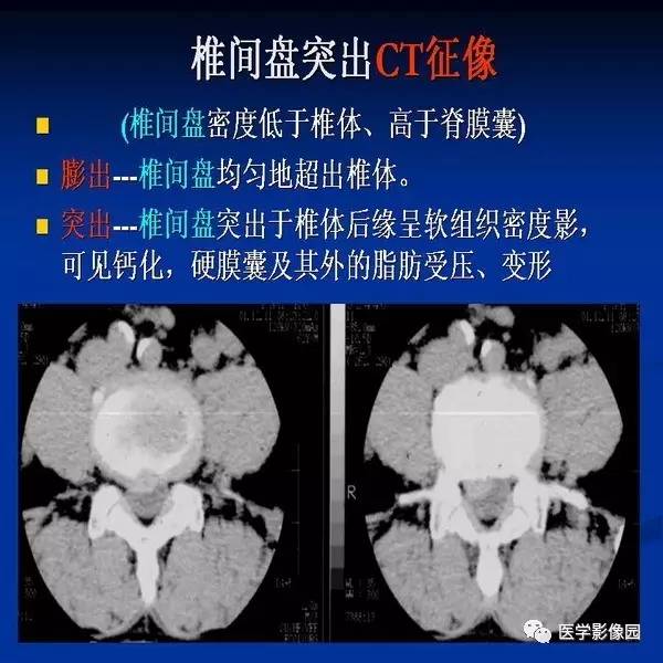 【PPT】颈椎病影像诊断