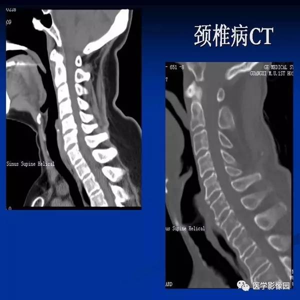 【PPT】颈椎病影像诊断