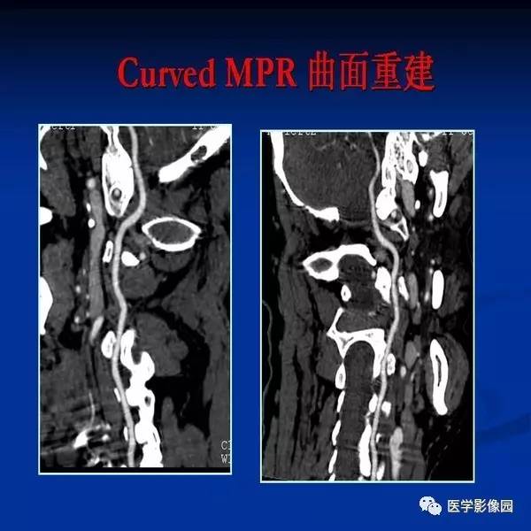 【PPT】颈椎病影像诊断