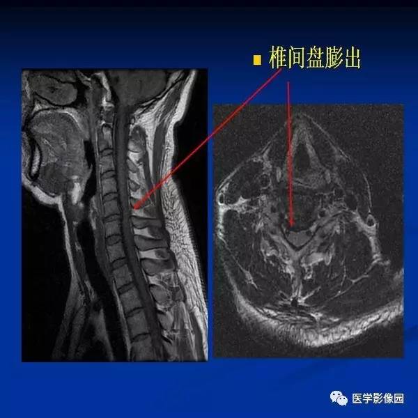 【PPT】颈椎病影像诊断