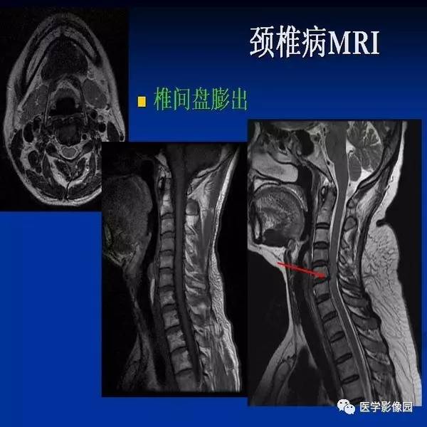 【PPT】颈椎病影像诊断