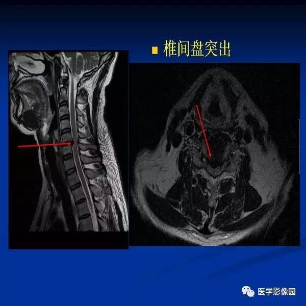 【PPT】颈椎病影像诊断
