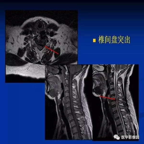 【PPT】颈椎病影像诊断