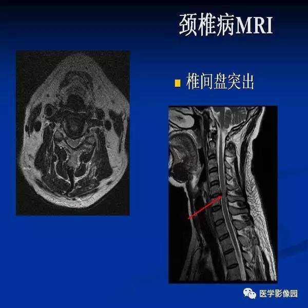 【PPT】颈椎病影像诊断