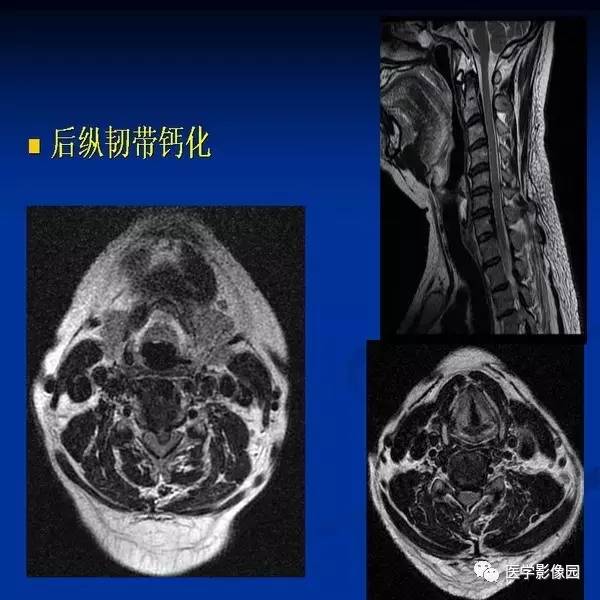 【PPT】颈椎病影像诊断