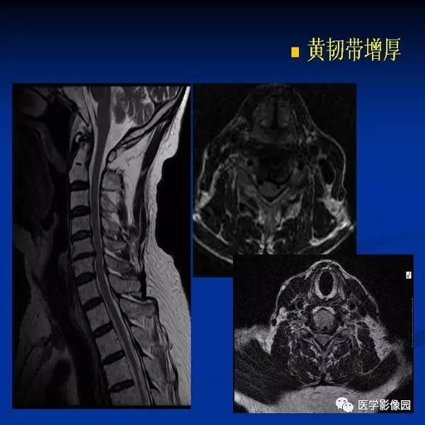 【PPT】颈椎病影像诊断