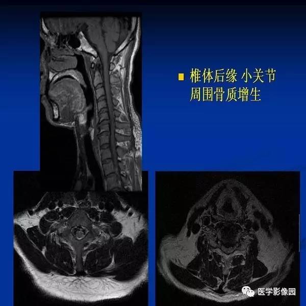 【PPT】颈椎病影像诊断