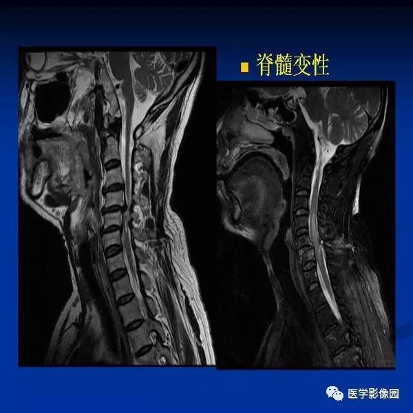 【PPT】颈椎病影像诊断