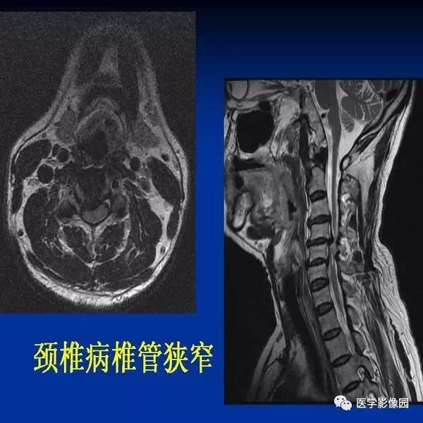 【PPT】颈椎病影像诊断