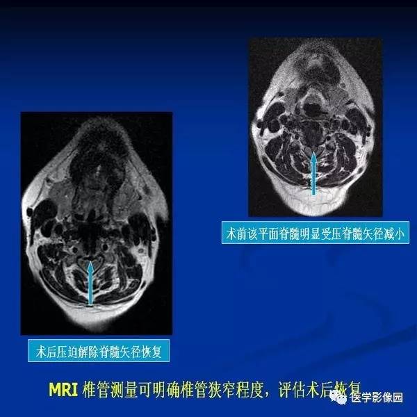 【PPT】颈椎病影像诊断