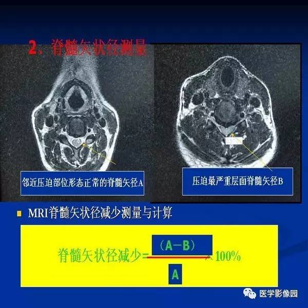 【PPT】颈椎病影像诊断