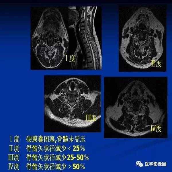 【PPT】颈椎病影像诊断