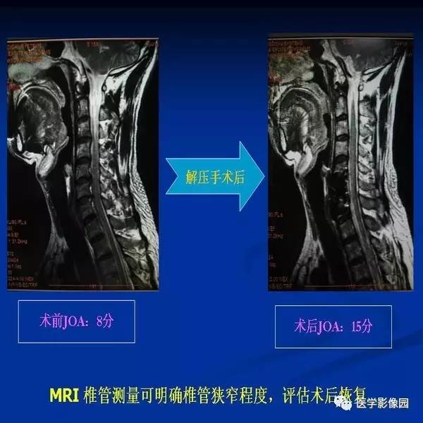 【PPT】颈椎病影像诊断
