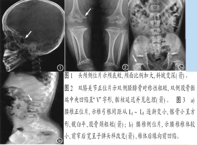 骨关节影像学征象——
