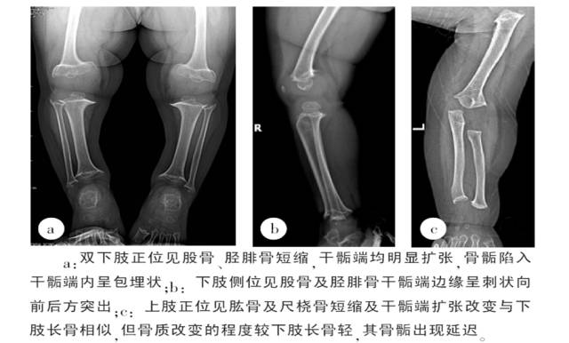 骨关节影像学征象——