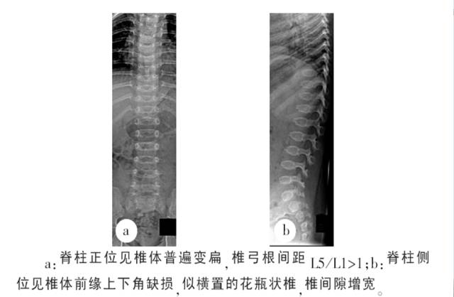 骨关节影像学征象——