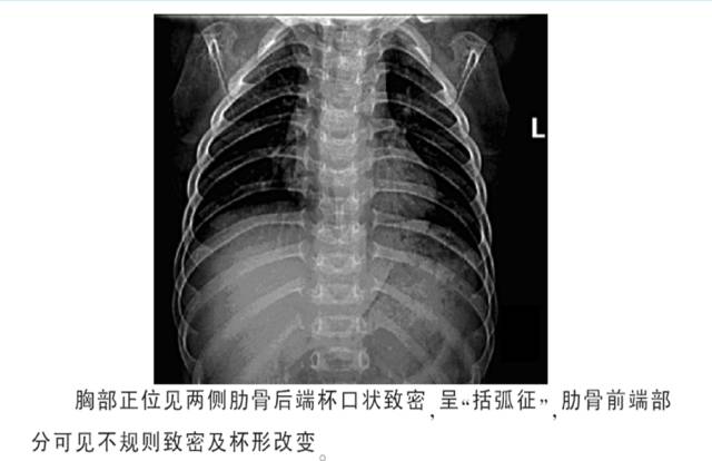 骨关节影像学征象——