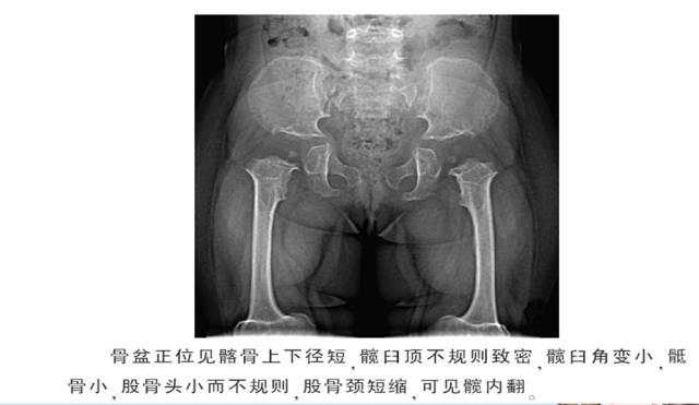 骨关节影像学征象——