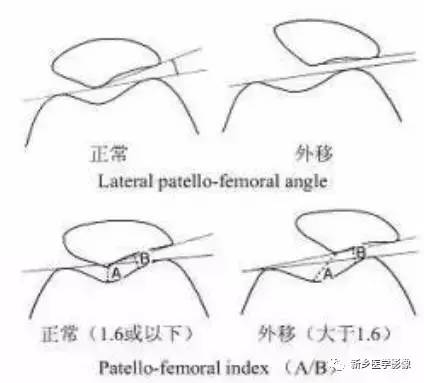 膝关节疼痛,应想到的22种疾病 膝关节疼痛,应想到的22种疾病