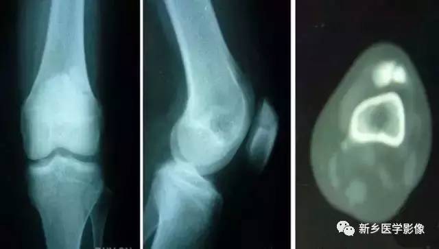 膝关节疼痛,应想到的22种疾病 膝关节疼痛,应想到的22种疾病