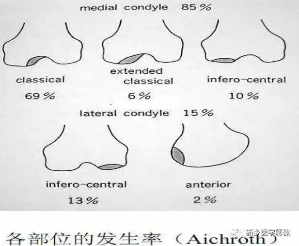 膝关节疼痛,应想到的22种疾病 膝关节疼痛,应想到的22种疾病