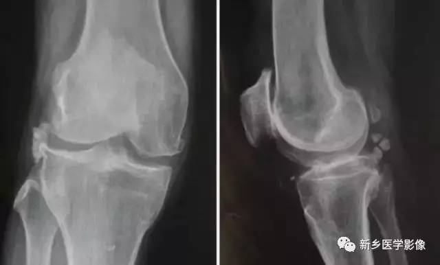 膝关节疼痛,应想到的22种疾病 膝关节疼痛,应想到的22种疾病