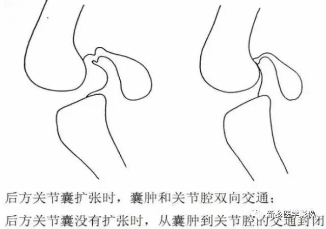 膝关节疼痛,应想到的22种疾病 膝关节疼痛,应想到的22种疾病